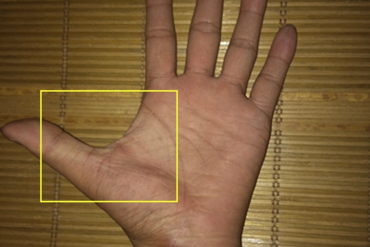 肌肉萎缩手掌症状图 肌肉萎缩手掌症状图