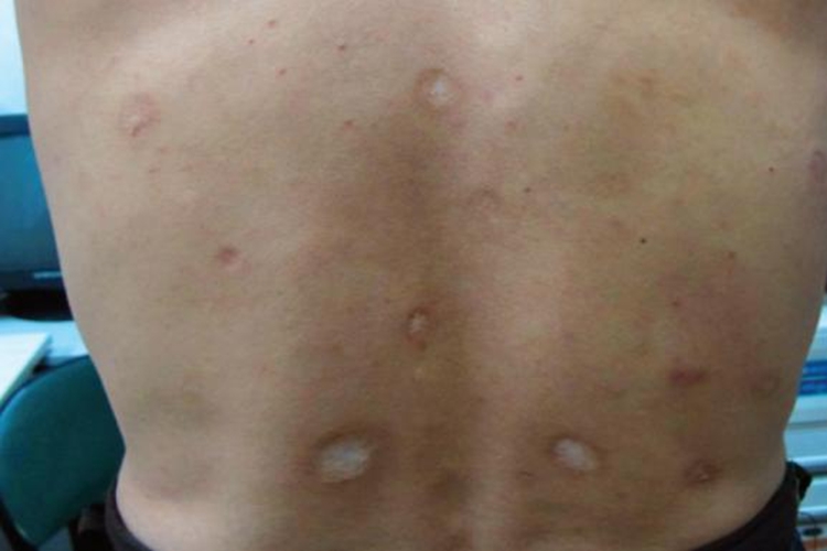 梅毒愈合留下的疤痕印图