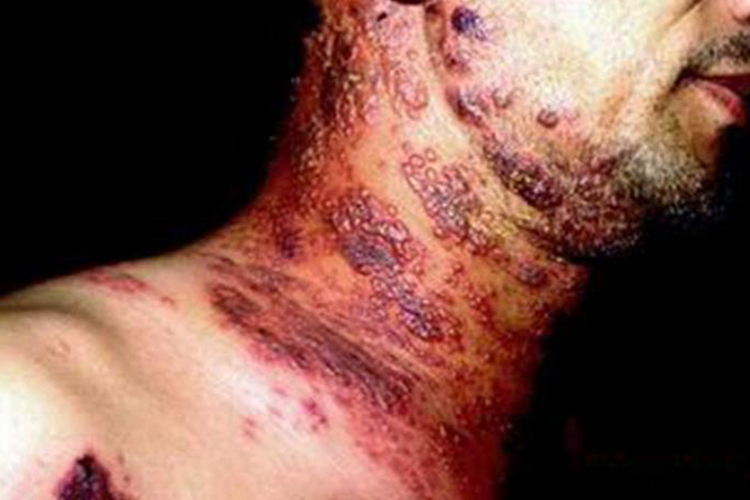 脖子上结节性梅毒疹图