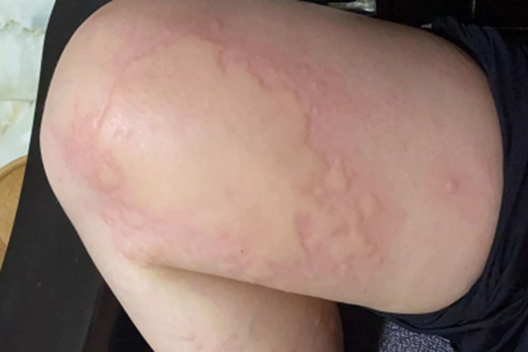 皮肤过敏红肿大腿风团图