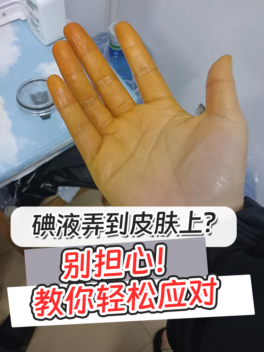 碘液弄到皮肤上?别担心!教你轻松应对