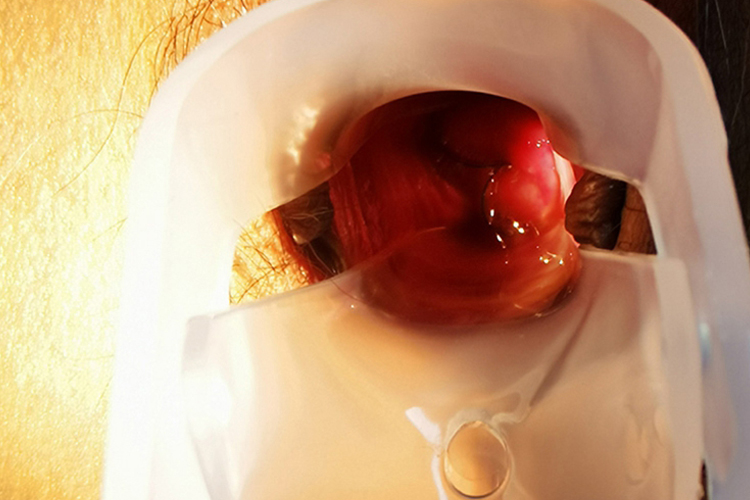 急性宫颈炎子宫颈充血图