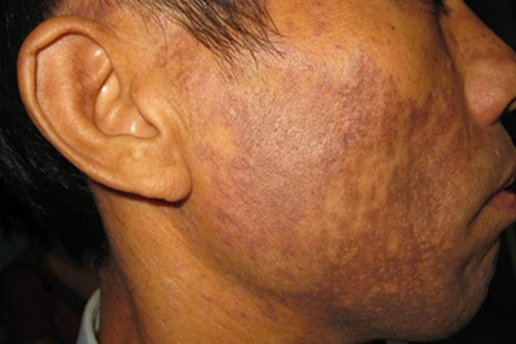 职业性黑变病面部症状图 职业性黑变病面部症状图