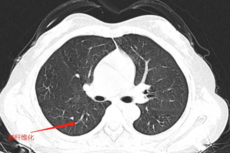 肺纤维化CT图