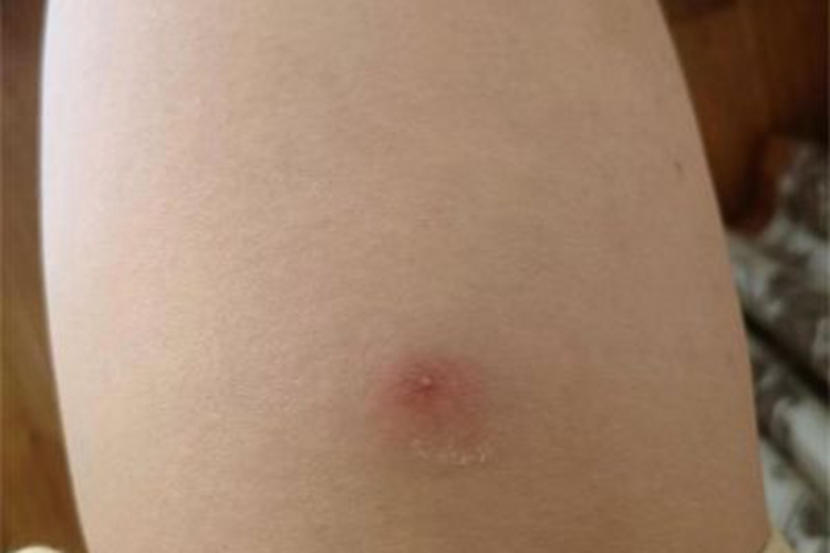 毛囊炎胳膊上有红色丘疹图