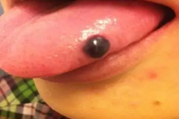 舌外伤创伤性血疱图