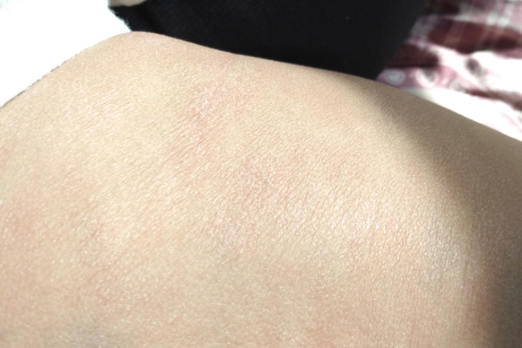 后背干燥起皮屑生理现象图