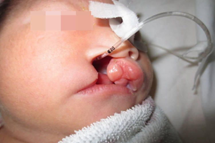 唇腭裂一侧嘴唇和鼻孔相通图 唇腭裂一侧嘴唇和鼻孔相通图