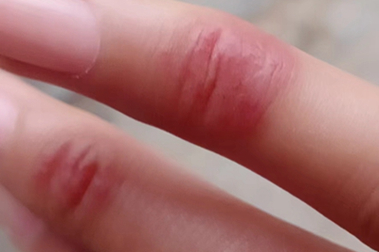 手部湿疹手指明显红肿图