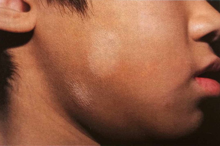 花斑糠疹面部脱屑图 花斑糠疹面部脱屑图