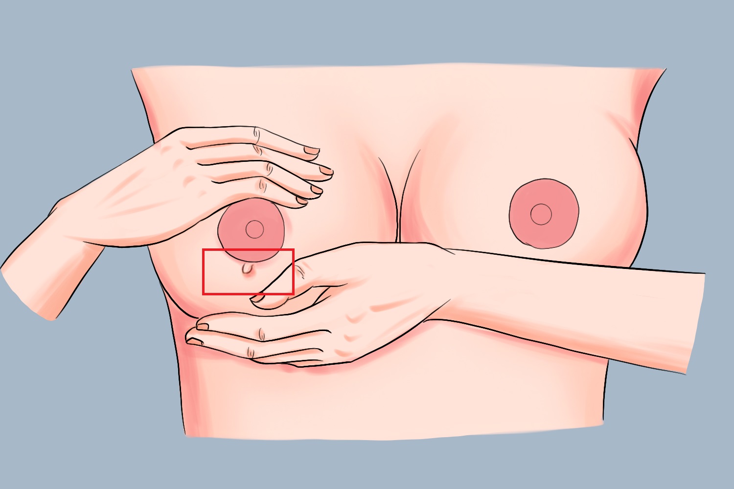 乳头软纤维瘤图 乳头软纤维瘤图