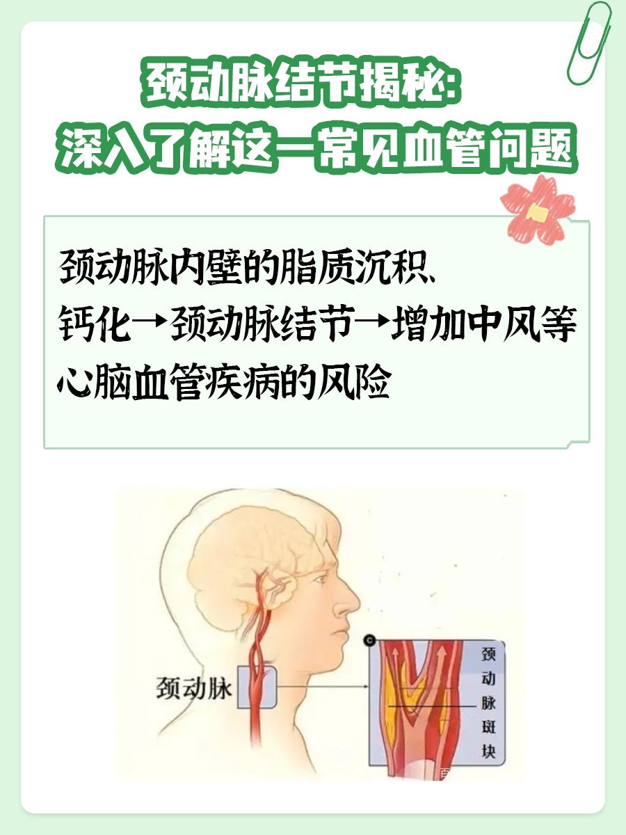 颈动脉结节揭秘:深入了解这一常见血管问题