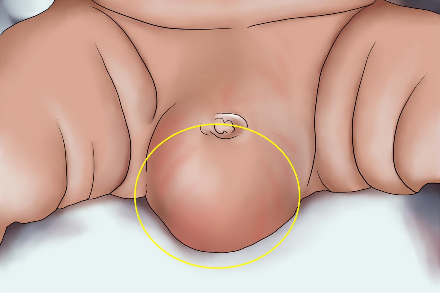 睾丸鞘膜积液阴囊症状手绘图