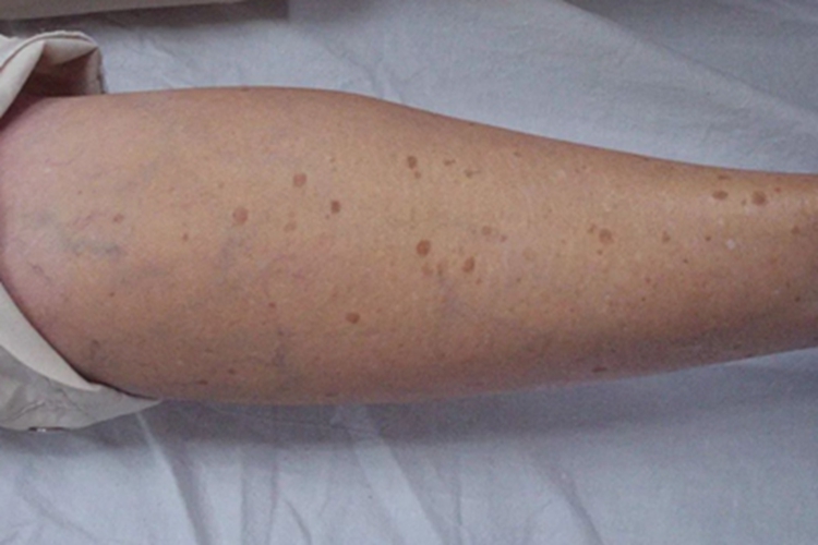 光线性角化病胳膊症状图