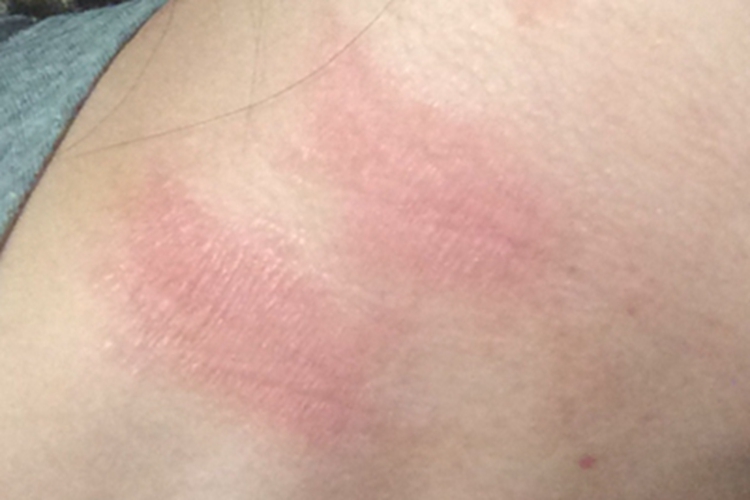 革螨皮炎后颈红斑图 革螨皮炎后颈红斑图