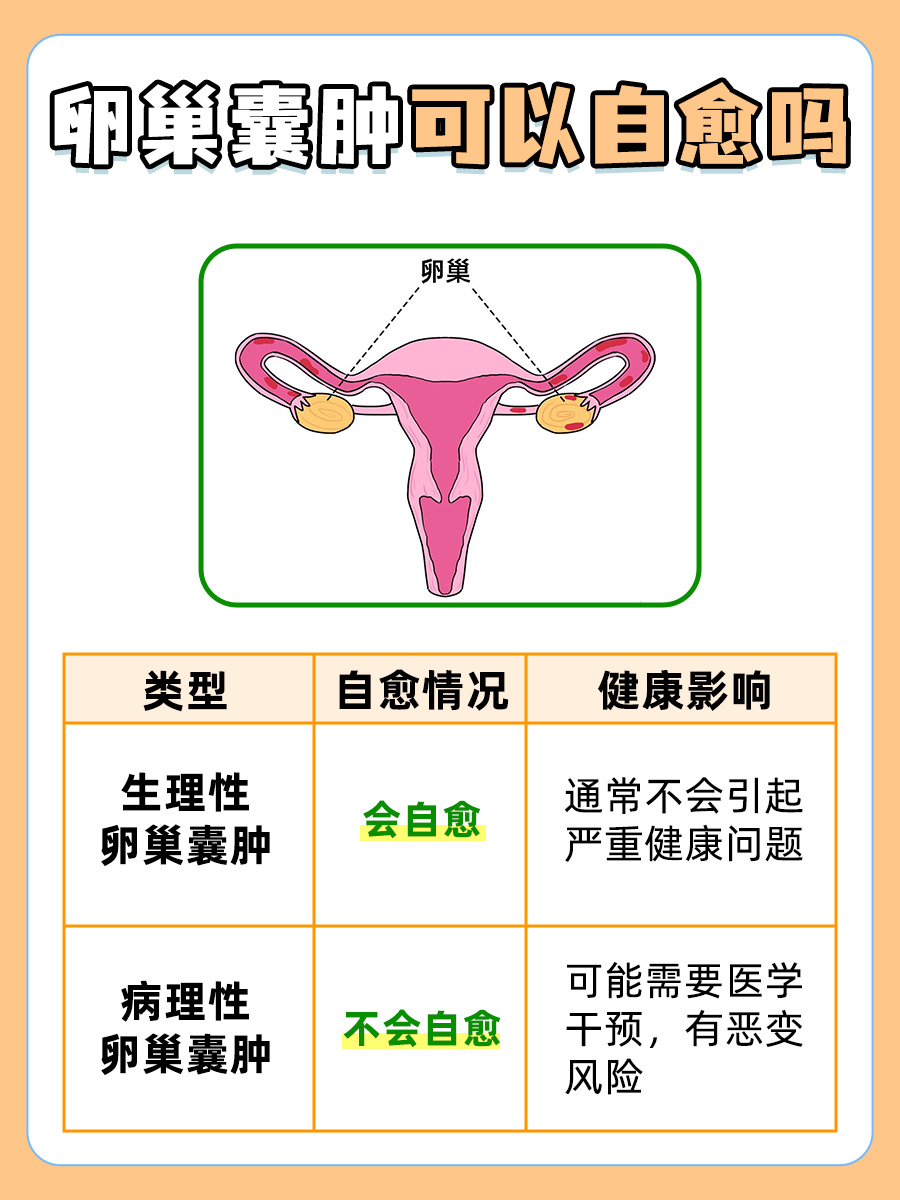 卵巢囊肿能否自愈？医生来回答你