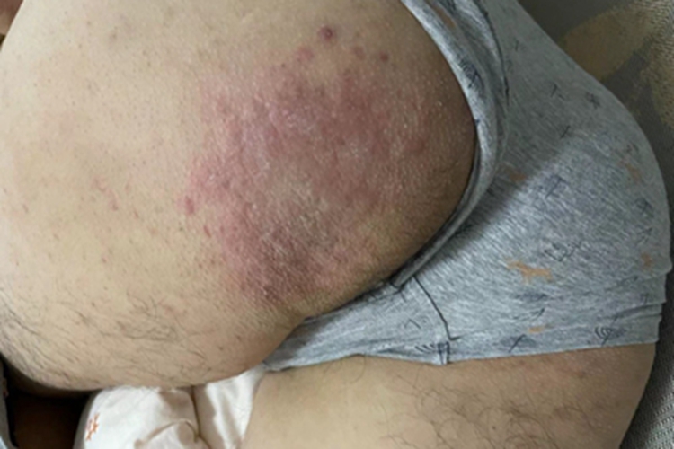 体癣臀部皮肤增厚图 体癣臀部皮肤增厚图