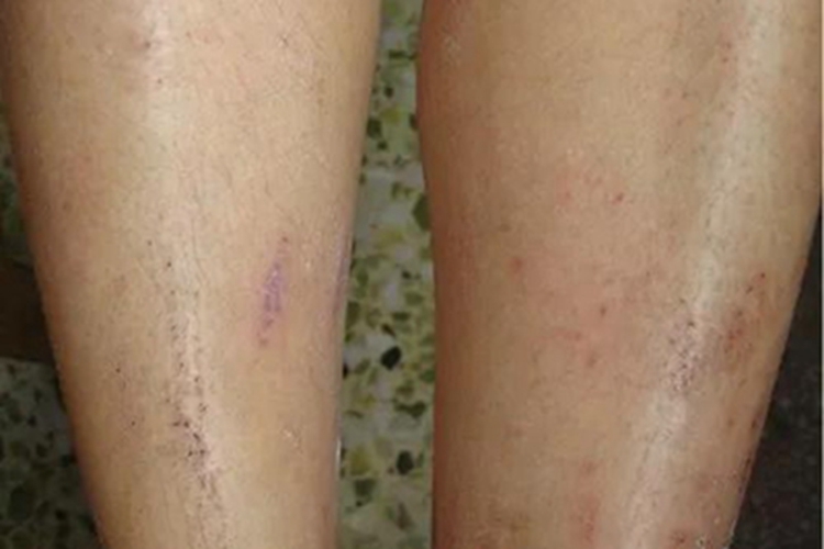 寄生虫妄想症小腿结痂图