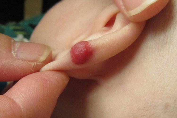 耳朵肿瘤种类较多,良性肿瘤常见血管瘤和纤维瘤,恶性肿瘤常见鳞癌和