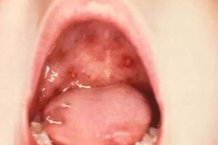 手足口病上颚红点像出血图