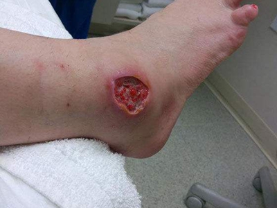 蜘蛛蜇伤的症状和图片 - 有来医生