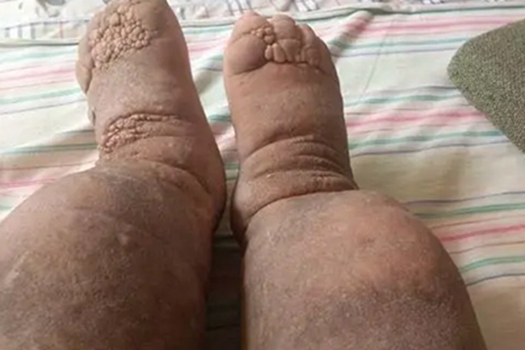 淋巴水肿脚背疙瘩图 淋巴水肿脚背疙瘩图