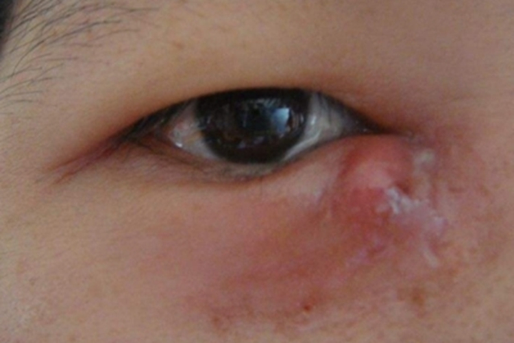 眶隔前蜂窝织炎眼部脓包图