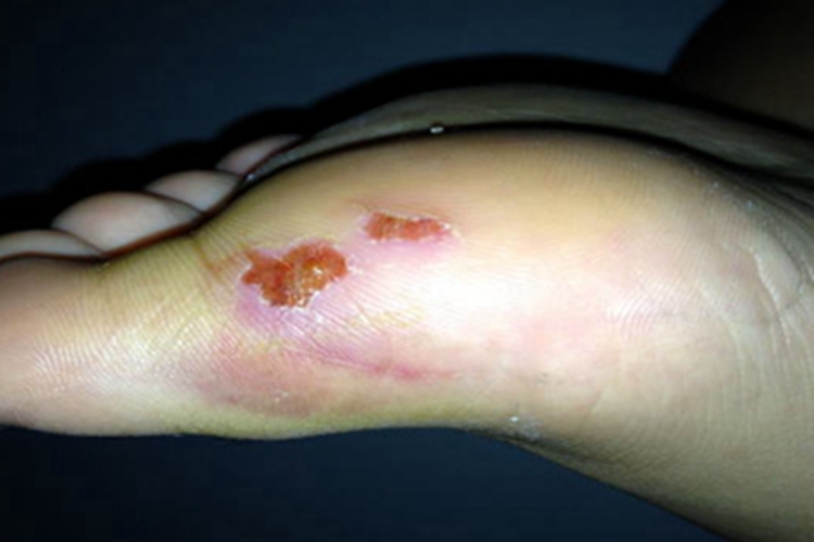 破伤风脚底症状图 破伤风脚底症状图