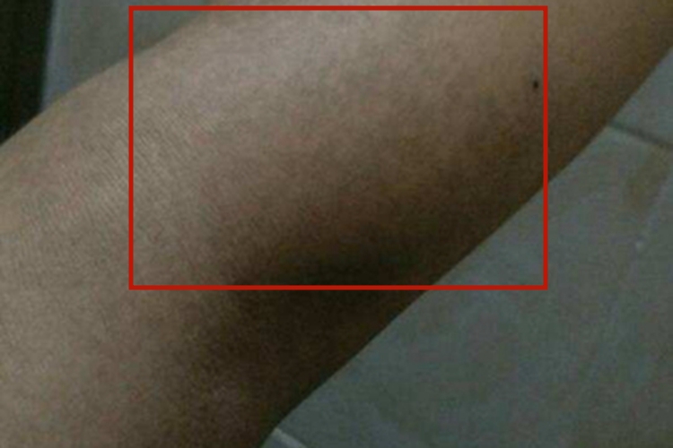 摩擦黑变病胳膊变黑图