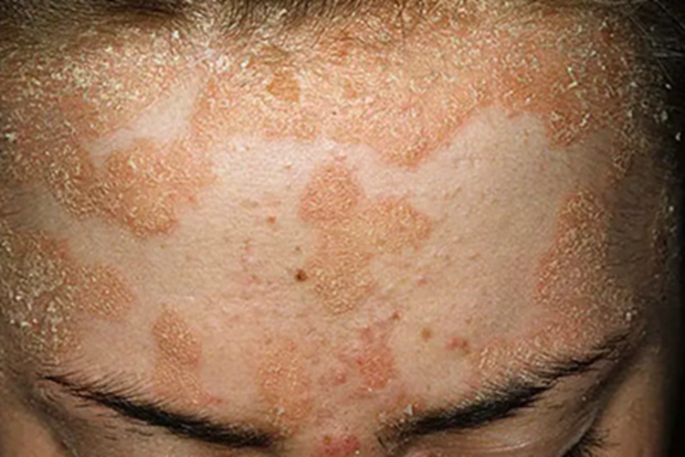 寻常型银屑病前额症状图 寻常型银屑病前额症状图