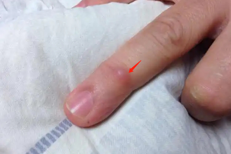 手指皮脂腺囊肿图 手指皮脂腺囊肿图