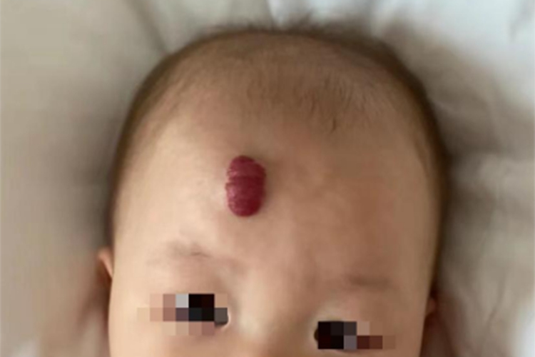 蔓状血管瘤前额症状图 蔓状血管瘤前额症状图