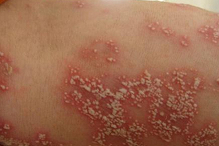 泛发性脓疱型银屑病胳膊症状图