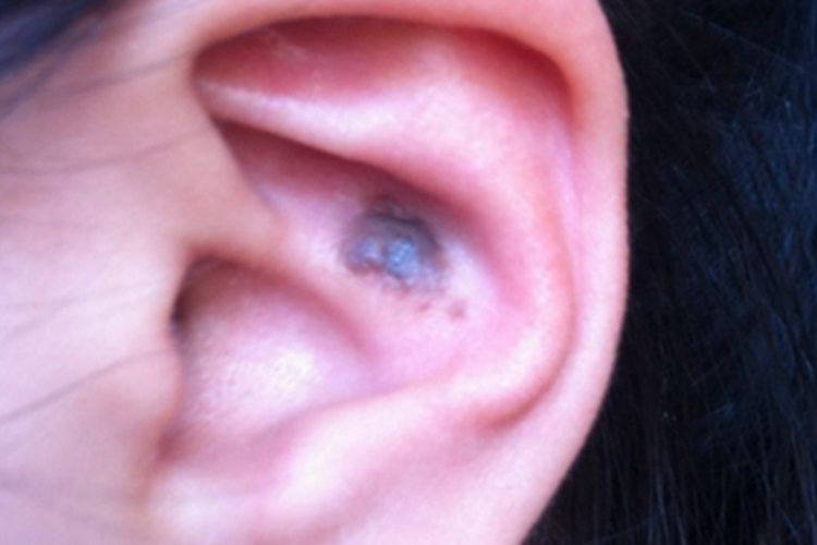 浅表播散型黑色素瘤耳廓黑斑图