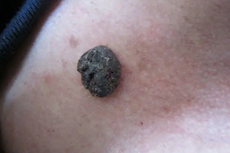 结节型黑色素瘤颈部症状图