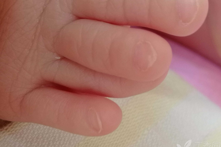 宝宝脚趾重叠图