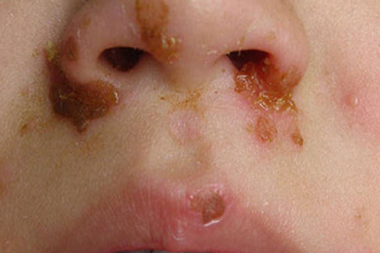 接触传染性脓疱疮图