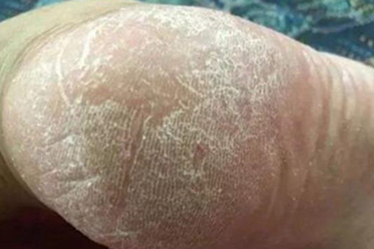 鱼鳞病脚后跟脱屑图
