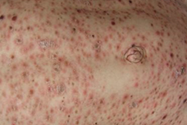 痘疮样型副银屑病症状图 痘疮样型副银屑病症状图