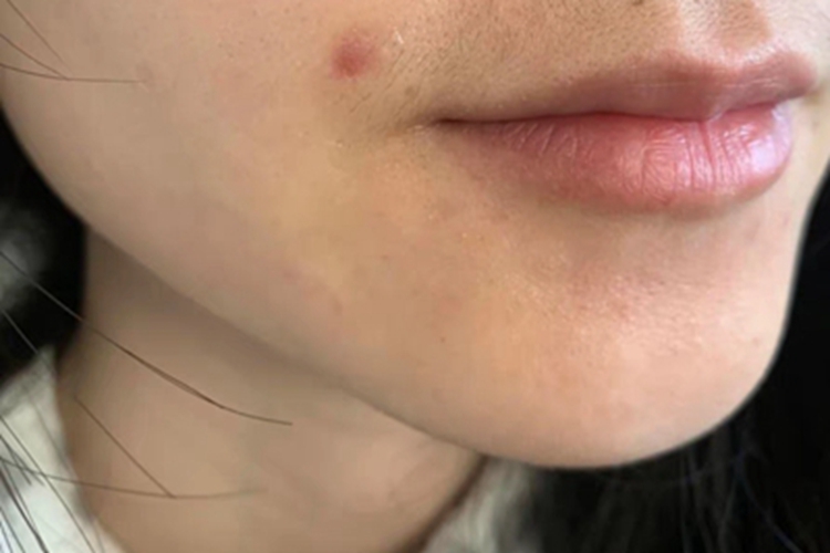 交界痣口周疤痕图