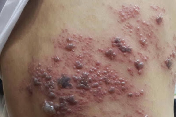 艾滋病带状疱疹图