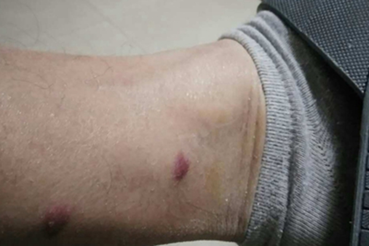 丘疹性荨麻疹脚踝症状图 丘疹性荨麻疹脚踝症状图