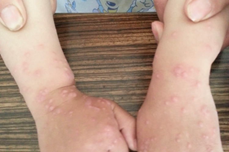 儿童丘疹性肢端皮炎手背症状图