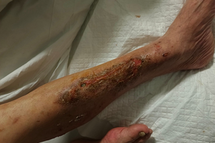 亚急性湿疹溃疡图 亚急性湿疹溃疡图