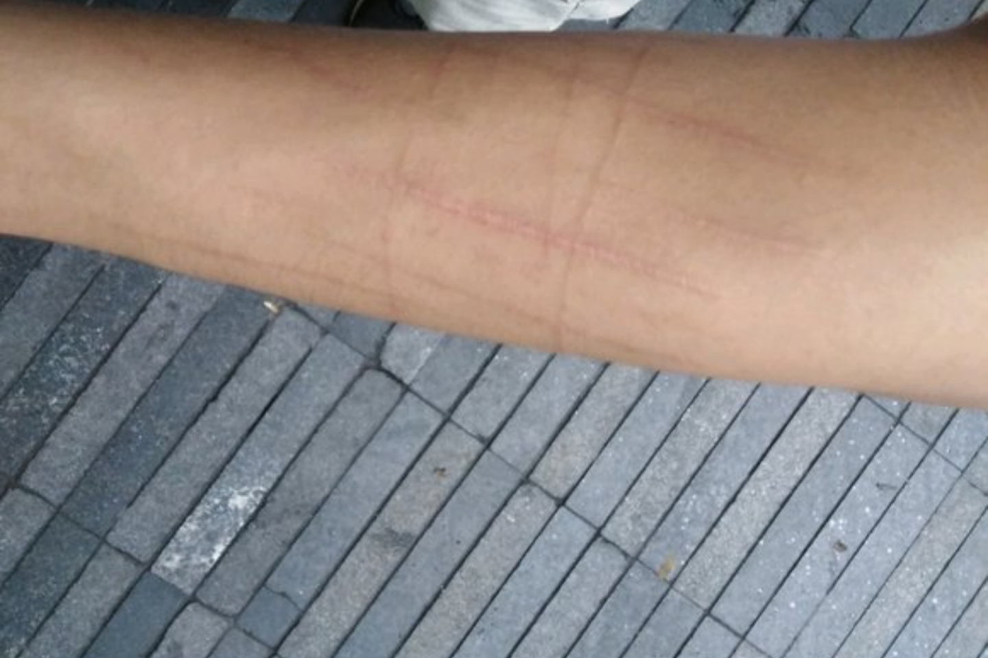 手臂自残伤疤痕图