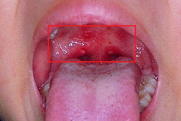 腮腺炎颊黏膜水肿溃疡图 腮腺炎颊黏膜水肿溃疡图