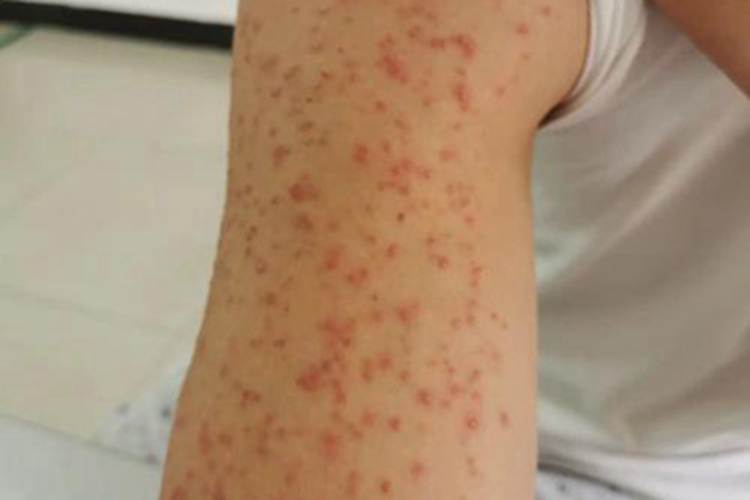 日光性皮炎小红疙瘩图 日光性皮炎小红疙瘩图