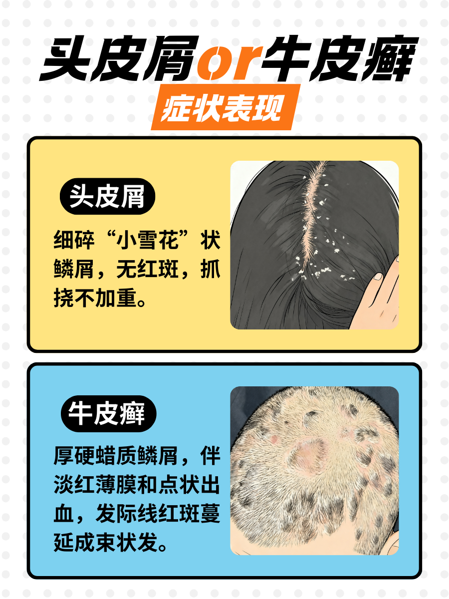 牛皮癣头皮屑，一篇说清自救指南