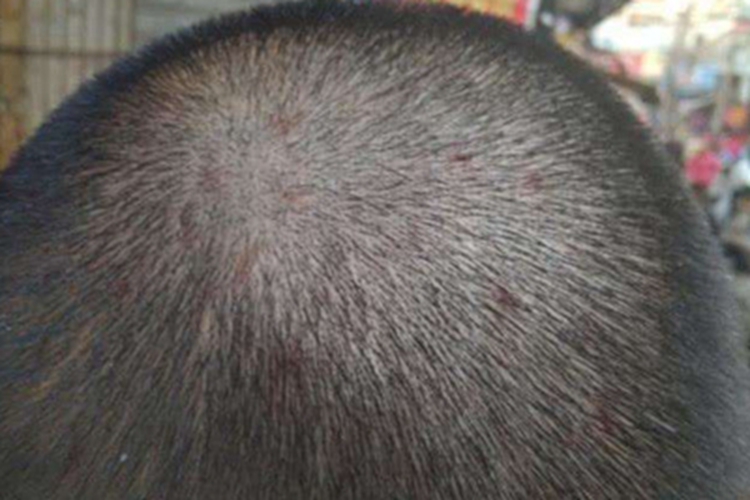 念珠状发头皮丘疹图 念珠状发头皮丘疹图