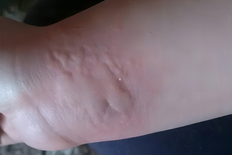 急性自发性荨麻疹图